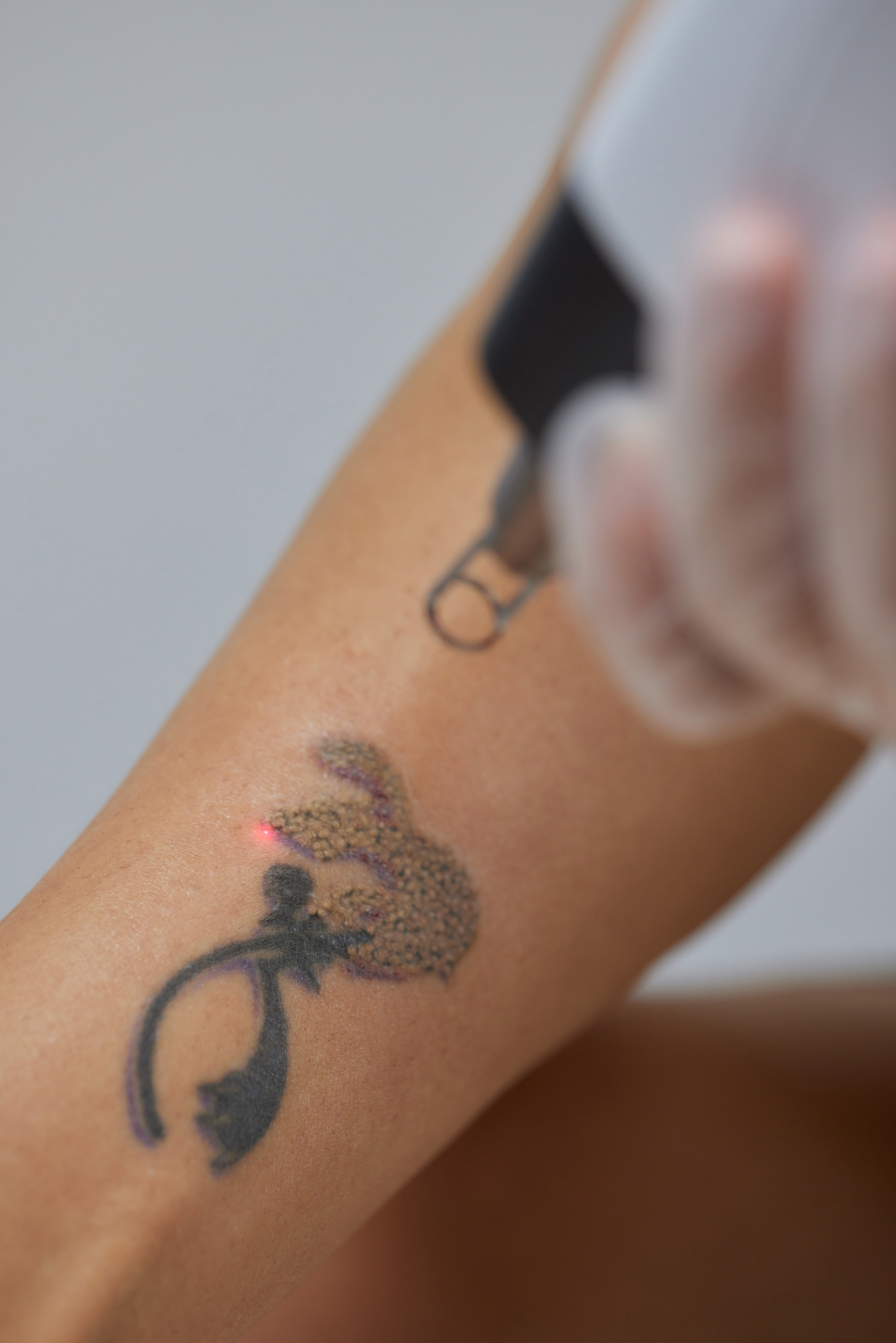 Eliminación de tatuajes