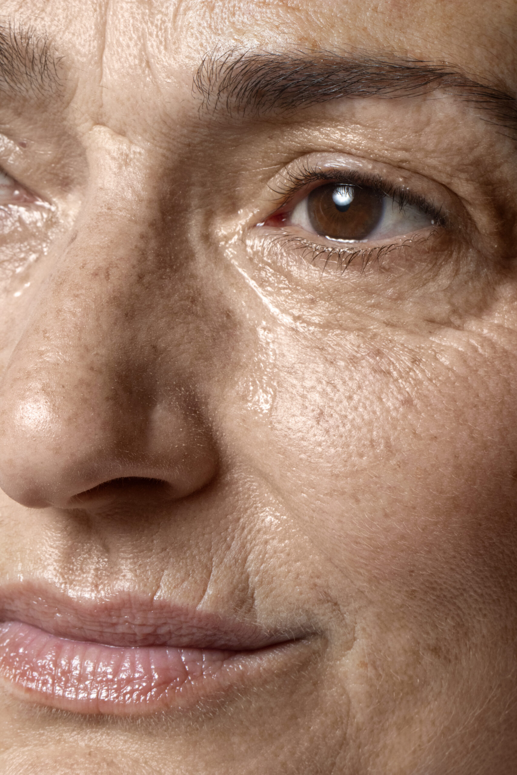 Melasma